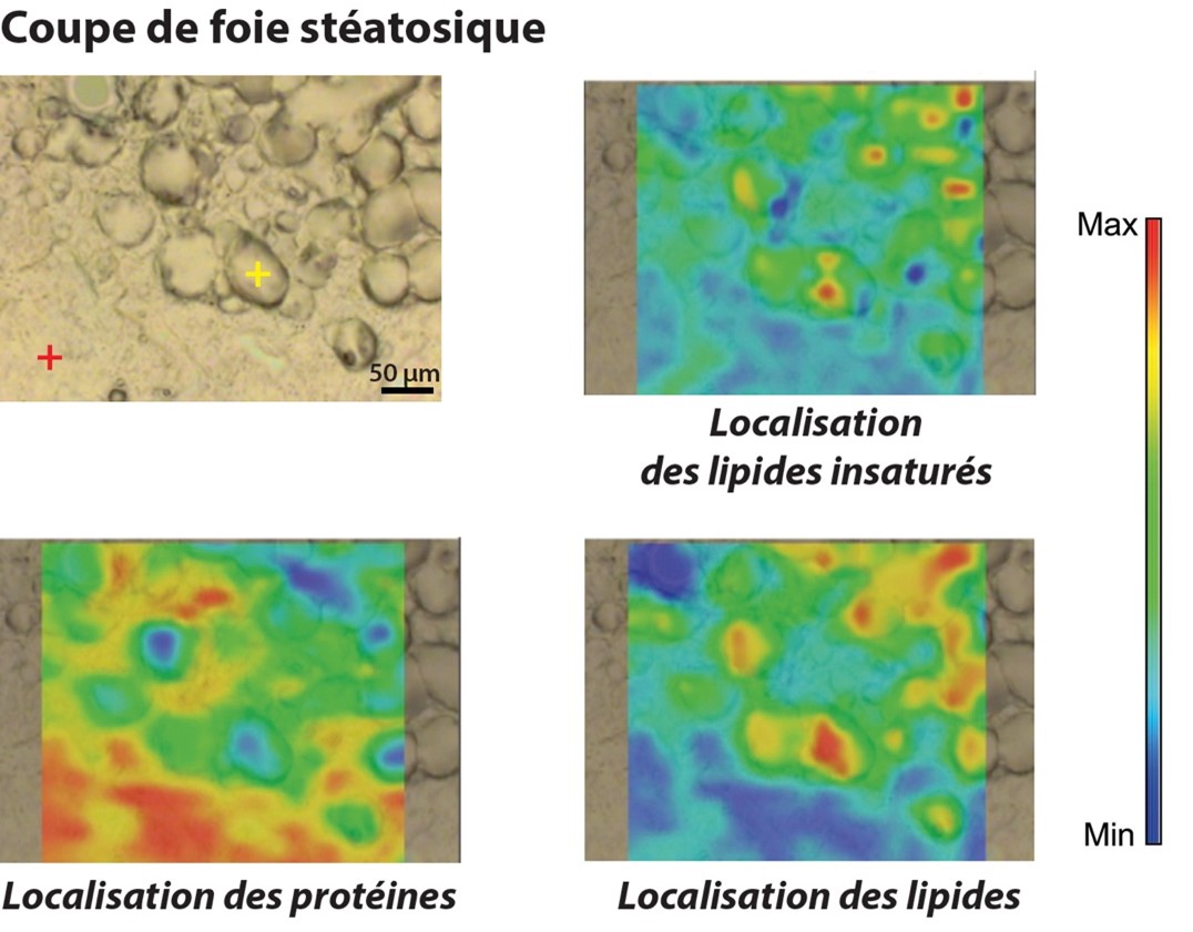 Coupe de foie stéatosique